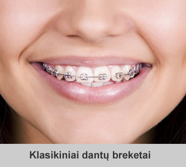 Ortodontiniai dantų breketai