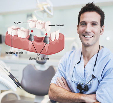 Implantavimas kai nėra kelių dantų vienoje eilėje