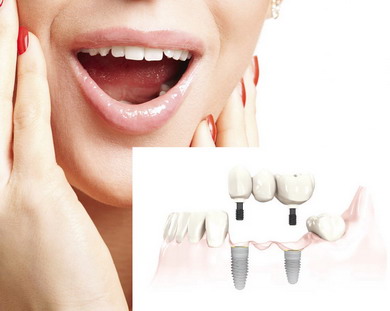 Dantų implantai ir tiltelis